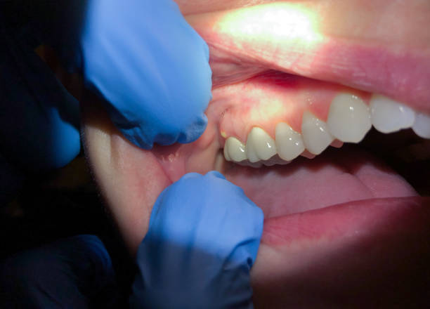 Best Emergency Root Canal Treatment in Memphis, TX